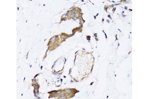 Immunohistochemistry of paraffin-embedded Human breast cancer using NAA10 Polyclonal Antibody at dilution of 1:100 (40x lens). (NAA10 antibody)