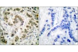 Immunohistochemistry analysis of paraffin-embedded human lung carcinoma tissue, using E2F4 Antibody. (E2F4 antibody  (AA 51-100))