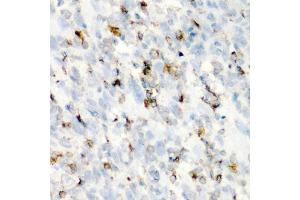 Immunohistochemistry of paraffin-embedded human esophageal cancer using CD68 antibody (ABIN5975414) at dilution of 1/100 (40x lens). (CD68 antibody)