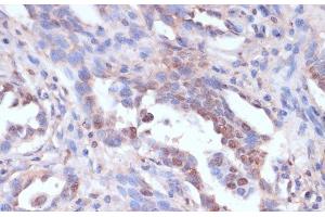Immunohistochemistry of paraffin-embedded Human lung cancer using CARTPT Polyclonal Antibody at dilution of 1:100 (40x lens). (CARTPT antibody)