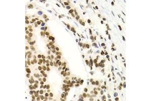 Immunohistochemistry of paraffin-embedded human breast cancer using NFKB2 Antibody. (NFKB2 antibody  (AA 690-899))