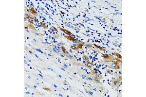 Immunohistochemistry of paraffin-embedded human liver cancer using USO1 antibody (ABIN1875291) at dilution of 1:100 (40x lens). (USO1 antibody)