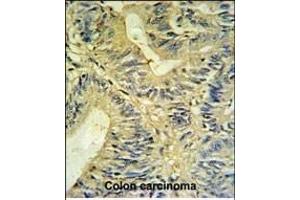 LXN Antibody (ABIN6242431 and ABIN6579060) IHC analysis in formalin fixed and paraffin embedded colon carcinoma followed by peroxidase conjugation of the secondary antibody and DAB staining. (Latexin antibody)