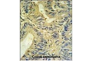 LXN Antibody (ABIN6242431 and ABIN6579060) IHC analysis in formalin fixed and paraffin embedded colon carcinoma followed by peroxidase conjugation of the secondary antibody and DAB staining.