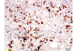 Formalin-fixed and paraffin embedded human lung carcinoma labeled with Anti-CD15/Fut4/SSEA-1 Polyclonal Antibody, Unconjugated (ABIN733193) at 1:200 followed by conjugation to the secondary antibody and DAB staining. (CD15 antibody  (AA 251-295))