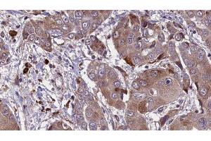ABIN6276579 at 1/100 staining Human liver cancer tissue by IHC-P. (KCNE1 antibody  (Internal Region))