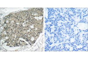 Peptide - +Immunohistochemical analysis of paraffin-embedded human breast carcinoma tissue using Akt (Ab-308) antibody (#B7005). (AKT1 antibody  (Thr308))