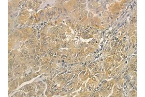 ABIN6262800 and ABIN6273259 at 1/100 staining human lung adenocarcinoma by IHC-P.
