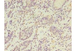 Immunohistochemistry of paraffin-embedded human gastric cancer using ABIN7169047 at dilution of 1:100 (PSKH2 antibody  (AA 63-320))