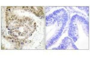 Immunohistochemistry analysis of paraffin-embedded human colon carcinoma tissue using hnRNP L antibody. (HNRNPL antibody  (N-Term))