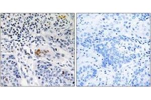 Immunohistochemistry analysis of paraffin-embedded human lung carcinoma tissue, using ZBTB40 Antibody.