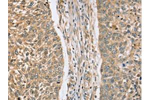 The image on the left is immunohistochemistry of paraffin-embedded Human lung cancer tissue using ABIN7130828(RASSF4 Antibody) at dilution 1/25, on the right is treated with fusion protein. (RASSF4 antibody)