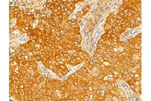 ABIN6265403 and ABIN6273018 at 1/100 staining Human lung cancer by IHC-P.