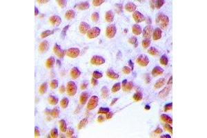 Immunohistochemical analysis of ZNF24 staining in human breast cancer formalin fixed paraffin embedded tissue section. (ZNF24 antibody  (N-Term))
