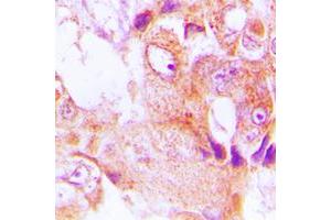 Immunohistochemical analysis of ABHD9 staining in human lung cancer formalin fixed paraffin embedded tissue section. (ABHD9 antibody  (Center))