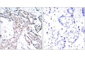 Immunohistochemistry (IHC) image for anti-Signal Transducer and Activator of Transcription 3 (Acute-Phase Response Factor) (STAT3) (AA 694-743), (pSer727) antibody (ABIN1531975)