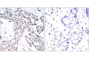 Immunohistochemistry analysis of paraffin-embedded human breast carcinoma, using STAT3 (Phospho-Ser727) Antibody.