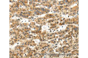 Immunohistochemistry of Human thyroid cancer using PAPPA Polyclonal Antibody at dilution of 1:50 (PAPPA antibody)
