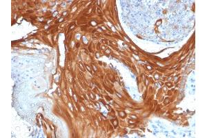 Formalin-fixed, paraffin-embedded human Basal Cell Carcinoma stained with Cytokeratin 6A (KRT6A) Mouse Monoclonal Antibody (KRT6A/2368). (KRT6A antibody)
