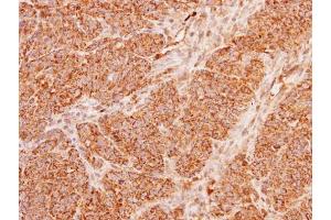 IHC-P Image Immunohistochemical analysis of paraffin-embedded DLD1 xenograft, using ACADM, antibody at 1:100 dilution. (Medium-Chain Specific Acyl-CoA Dehydrogenase, Mitochondrial (N-Term) antibody)