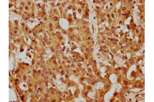 IHC image of ABIN7169288 diluted at 1:200 and staining in paraffin-embedded human liver cancer performed on a Leica BondTM system. (PP5 antibody  (AA 370-488))