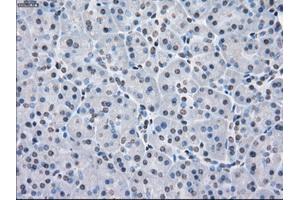 Immunohistochemical staining of paraffin-embedded Adenocarcinoma of colon tissue using anti-PPP5Cmouse monoclonal antibody. (PP5 antibody)