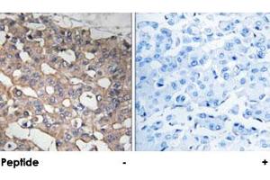 Immunohistochemical analysis of paraffin-embedded human breast carcinoma tissue using STMN1 polyclonal antibody . (Stathmin 1 antibody)