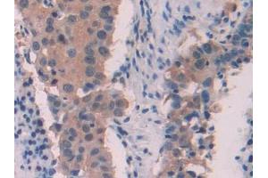 DAB staining on IHC-P; Samples: Human Lung cancer Tissue (MYL6 antibody  (AA 4-146))