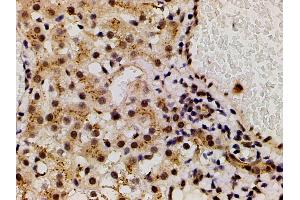 ABIN6267554 at 1/200 staining human vascular cancer tissue sections by IHC-P.