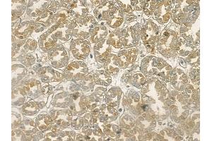 ABIN6255618 and ABIN6267141 at 1/100 staining human renal cell carcinoma by IHC-P. (MST1/MST2 (pThr180), (pThr183) antibody)
