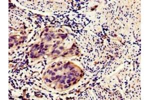 Immunohistochemistry of paraffin-embedded human bladder cancer using ABIN7155869 at dilution of 1:100 (HIPK3 antibody  (AA 841-1130))