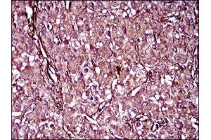 Immunohistochemical analysis of paraffin-embedded liver cancer tissues using MCAM mouse mAb with DAB staining.