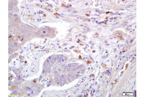 Formalin-fixed and paraffin embedded human lung carcinoma labeled with Anti-Caveolin-1 Polyclonal Antibody, Unconjugated (ABIN686752) at 1:200 followed by conjugation to the secondary antibody and DAB staining.