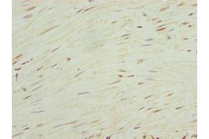 Immunohistochemistry of paraffin-embedded human colon cancer using ABIN7168034 at dilution of 1:100 (RhoF antibody  (AA 1-170))