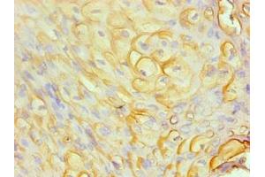 Immunohistochemical of paraffin-embedded human cervical cancer using ABIN7168559 at dilution of 1:200 (S1A8 antibody)