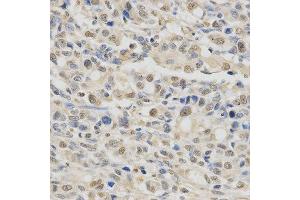 Immunohistochemistry of paraffin-embedded human stomach cancer using SPHK1 antibody at dilution of 1:200 (x400 lens). (SPHK1 antibody  (AA 50-384))
