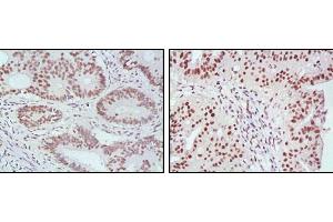 Immunohistochemical analysis of paraffin-embedded human rectum cancer (left) and ovarian cancer (right) tissues, showing nuclear localization with DAB staining using MLH1 mouse mAb.