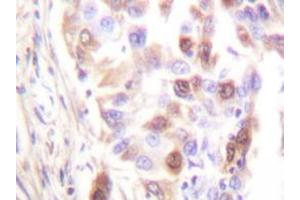 Immunohistochemistry analyzes of RFA2 antibody in paraffin-embedded human lung carcinoma tissue. (RPA2 antibody  (AA 115-129))