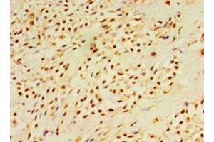 Immunohistochemistry of paraffin-embedded human breast cancer using ABIN7150785 at dilution of 1:100 (DUSP7 antibody  (AA 160-419))