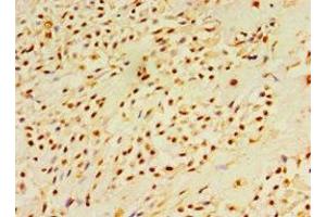 Immunohistochemistry of paraffin-embedded human breast cancer using ABIN7150785 at dilution of 1:100 (DUSP7 antibody  (AA 160-419))