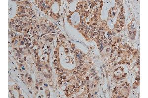 ABIN6267478 at 1/50 staining human colon cancer tissue sections by IHC-P. (CTNNB1 antibody  (pSer33))
