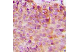 Immunohistochemical analysis of 14-3-3 eta staining in human breast cancer formalin fixed paraffin embedded tissue section. (14-3-3 eta antibody  (Center))