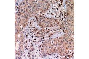 Immunohistochemical analysis of USP6NL staining in human breast cancer formalin fixed paraffin embedded tissue section.