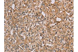 The image on the left is immunohistochemistry of paraffin-embedded Human prostate cancer tissue using ABIN7128941(CHRNA4 Antibody) at dilution 1/20, on the right is treated with fusion protein. (CHRNA4 antibody)