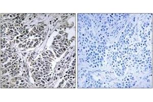 Immunohistochemistry analysis of paraffin-embedded human lung carcinoma tissue, using ATP5D Antibody.