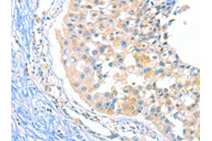 The image on the left is immunohistochemistry of paraffin-embedded Human breast cancer tissue using ABIN7129275(DUSP14 Antibody) at dilution 1/20, on the right is treated with fusion protein.