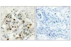 Immunohistochemistry analysis of paraffin-embedded human breast carcinoma tissue, using AF4 antibody. (AF4 antibody  (N-Term))