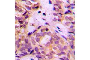 Immunohistochemical analysis of ALDH1A2 staining in human breast cancer formalin fixed paraffin embedded tissue section. (ALDH1A2 antibody  (C-Term))