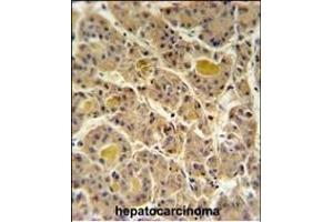 IN80D Antibody (N-term) (ABIN651234 and ABIN2840146) IHC analysis in formalin fixed and paraffin embedded human hepatocarcinoma followed by peroxidase conjugation of the secondary antibody and DAB staining. (IN80D antibody  (N-Term))