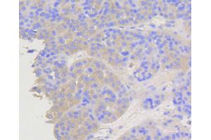 Immunohistochemistry of paraffin-embedded human liver cancer using ARRB1 antibody (ABIN5996907) at dilution of 1/100 (40x lens). (beta Arrestin 1 antibody)